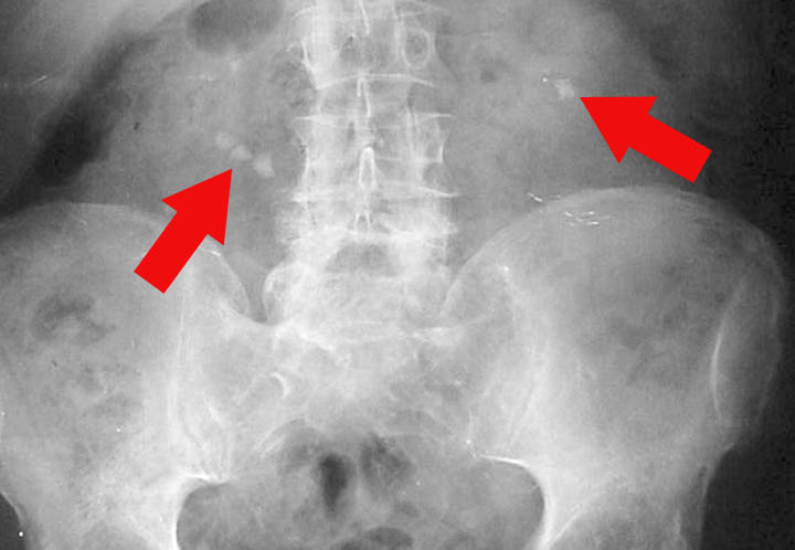 Kidney stones in an X-Ray - Source: Flickr.com - Arrow was added.